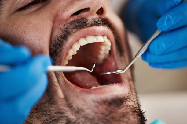 Best Emergency Root Canal Treatment in Chepachet, RI